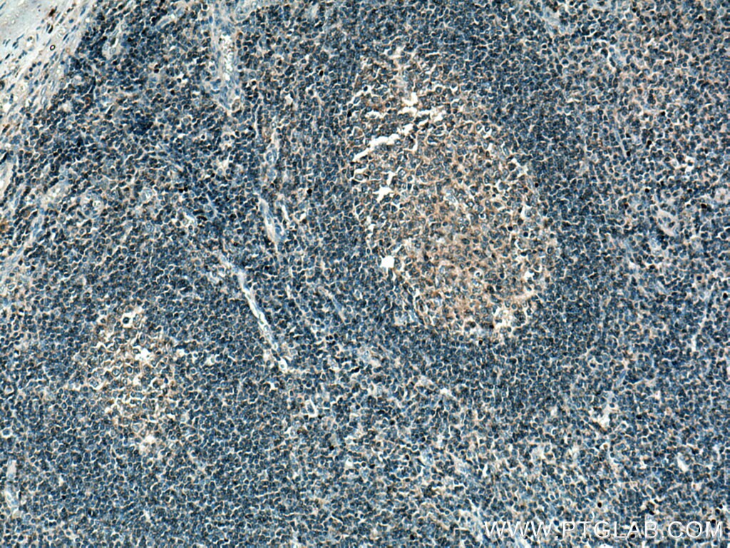 IHC staining of human tonsillitis using 28286-1-AP