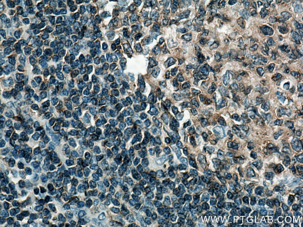 IHC staining of human tonsillitis using 28286-1-AP