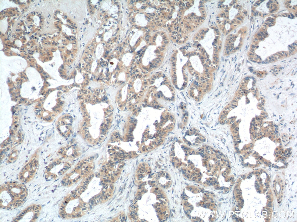 Immunohistochemistry (IHC) staining of human breast cancer tissue using PTPRE Polyclonal antibody (13922-1-AP)