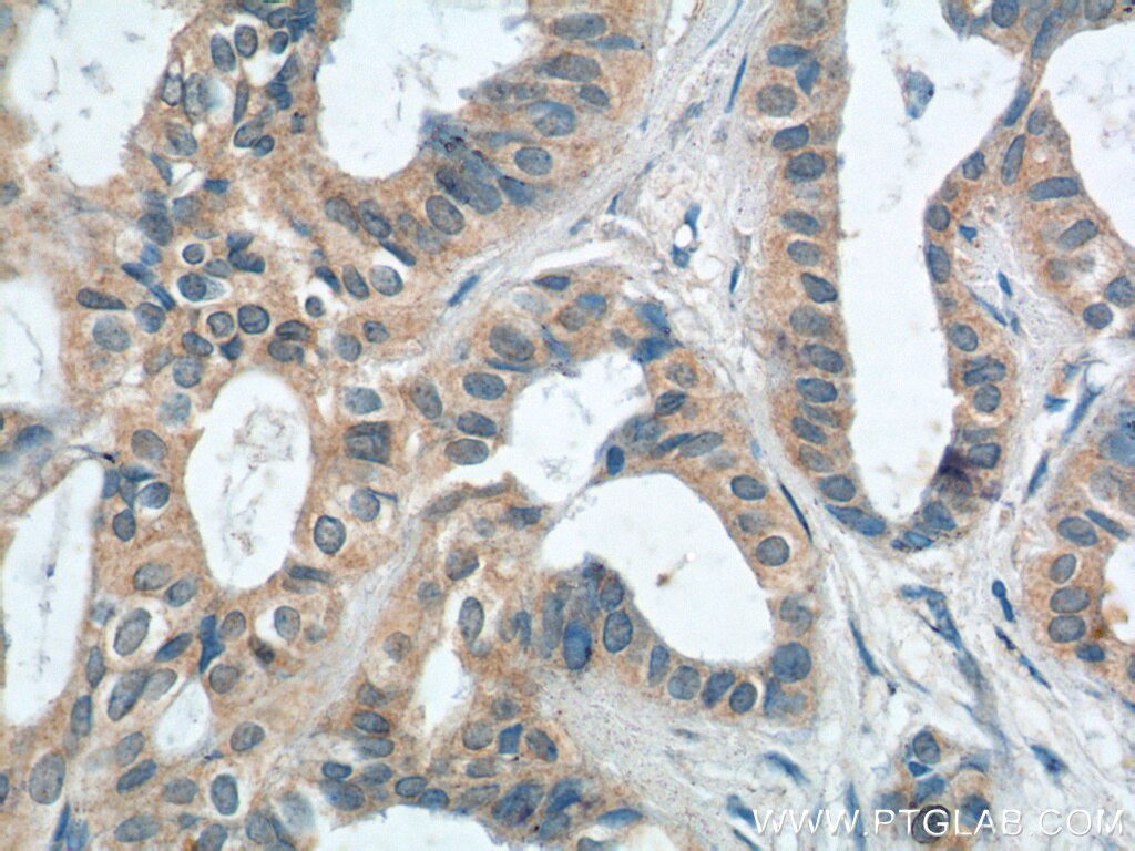 Immunohistochemistry (IHC) staining of human breast cancer tissue using PTPRE Polyclonal antibody (13922-1-AP)