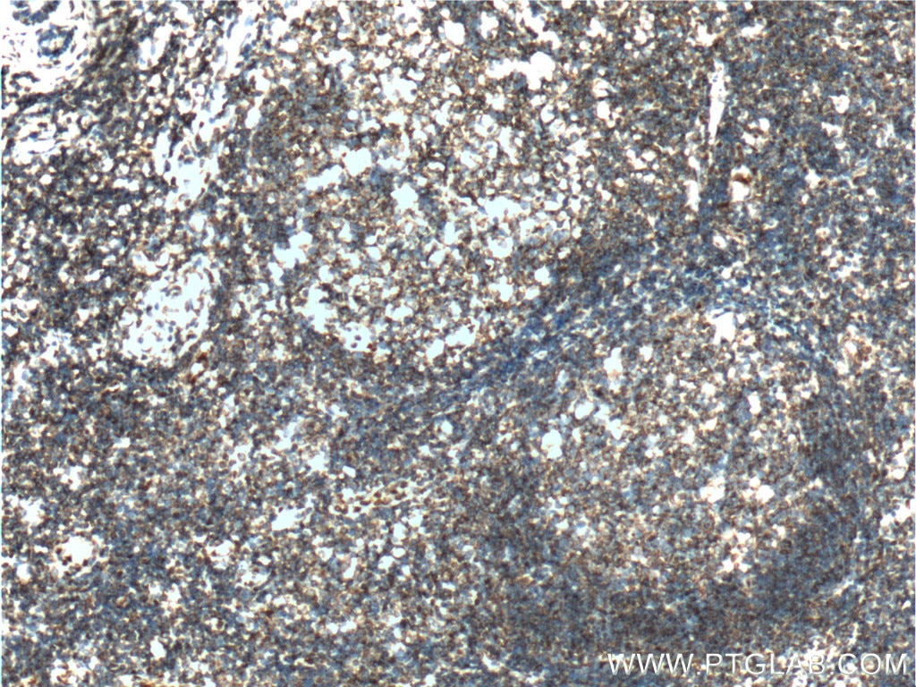 Immunohistochemistry (IHC) staining of human tonsillitis tissue using PTPRJ Polyclonal antibody (55123-1-AP)