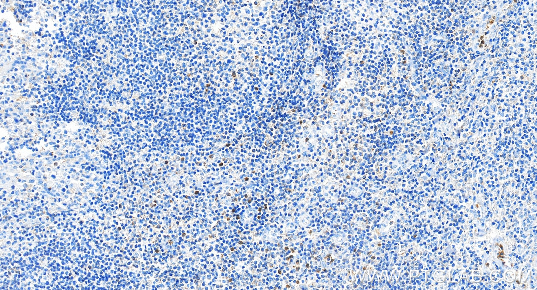 IHC staining of human tonsillitis using 98715-1-RR Immunohistochemistry (IHC) staining of human tonsillitis tissue using Anti-Human PTPRJ/CD148 Rabbit Recombinant Antibody (98715-1-RR)