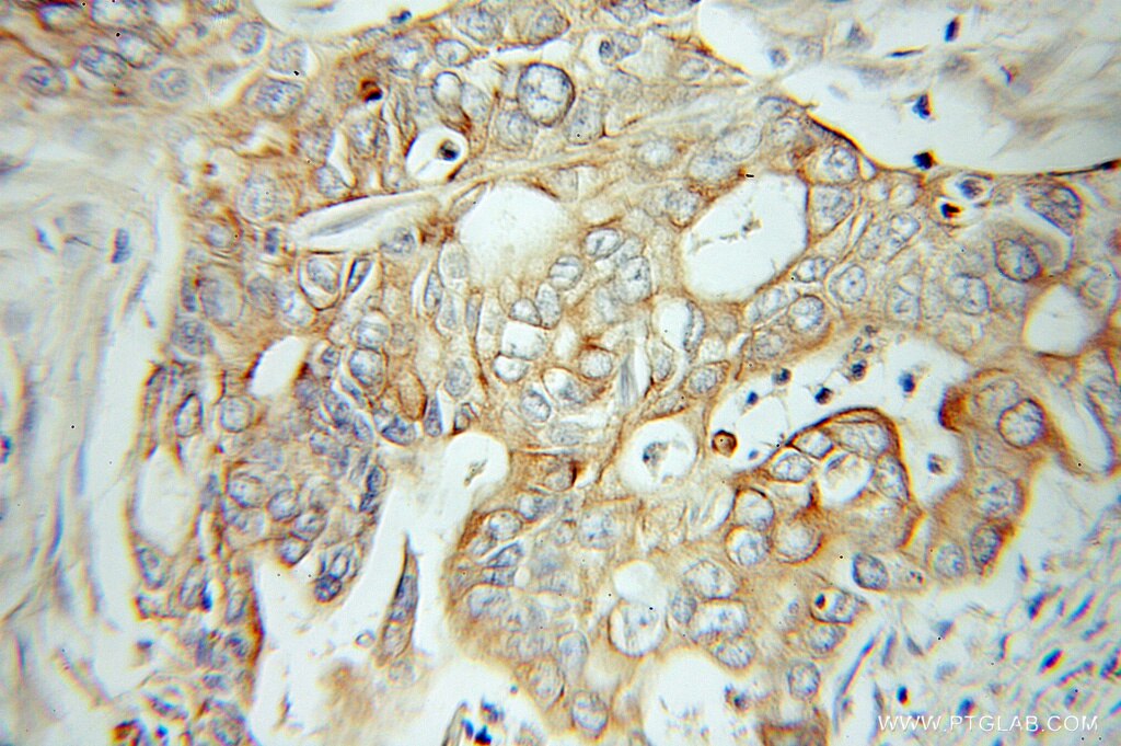 IHC staining of human pancreas cancer using 10584-1-AP