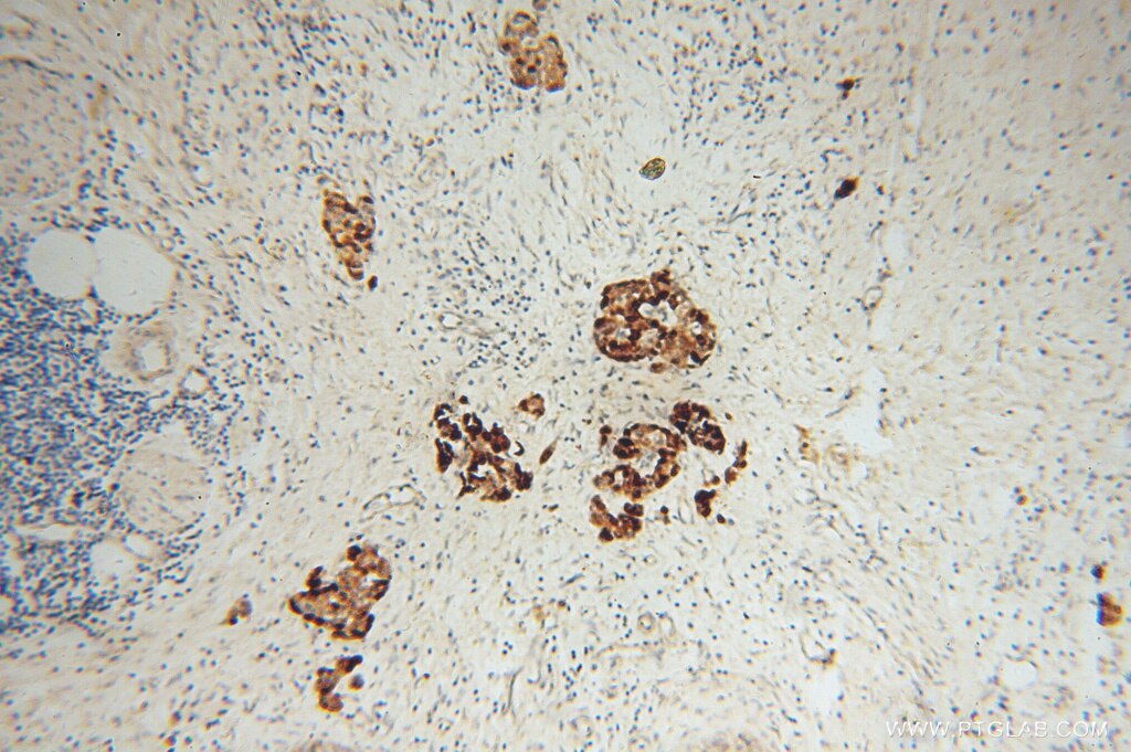 Immunohistochemistry (IHC) staining of human pancreas cancer tissue using IA-2/PTPRN Polyclonal antibody (10584-1-AP)