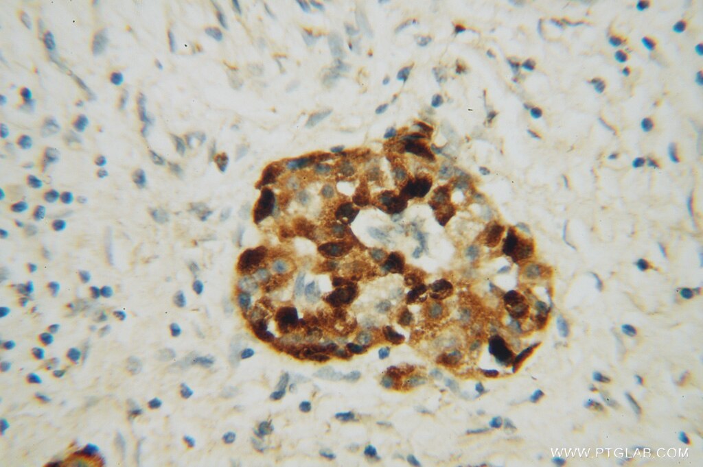 IHC staining of human pancreas cancer using 10584-1-AP