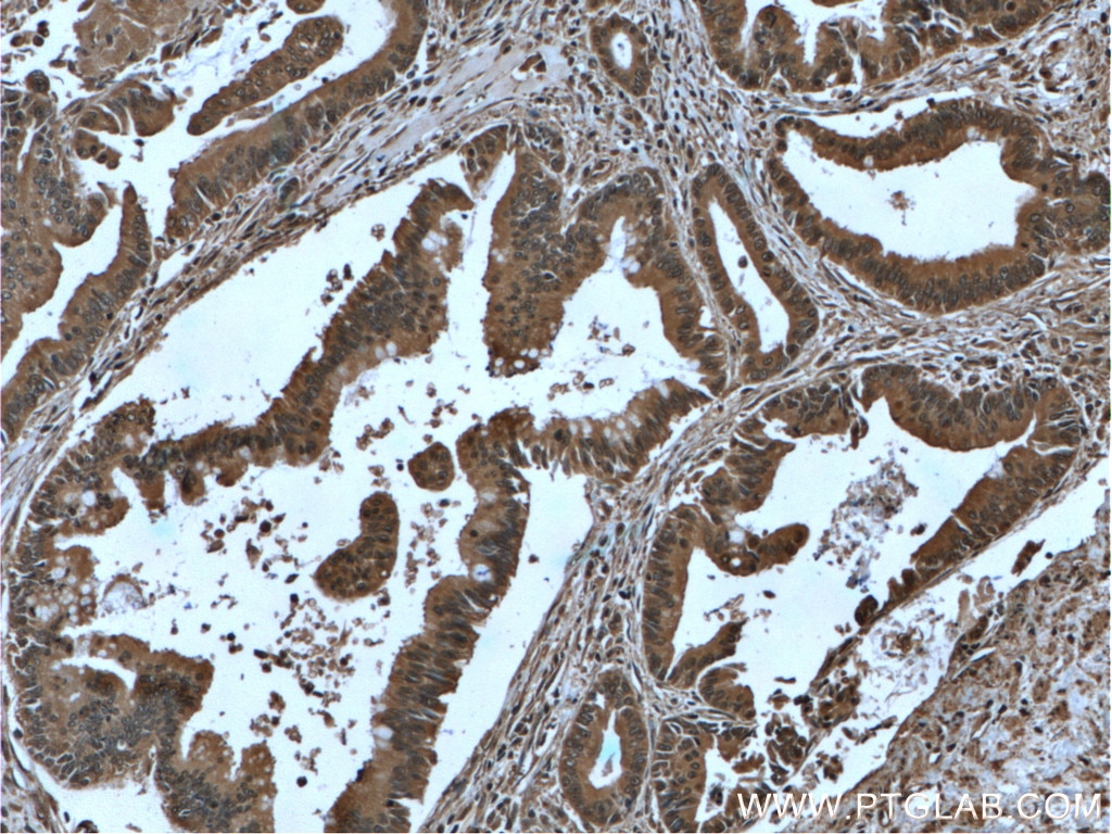 Immunohistochemistry (IHC) staining of human pancreas cancer tissue using IA-2/PTPRN Monoclonal antibody (66045-1-Ig)