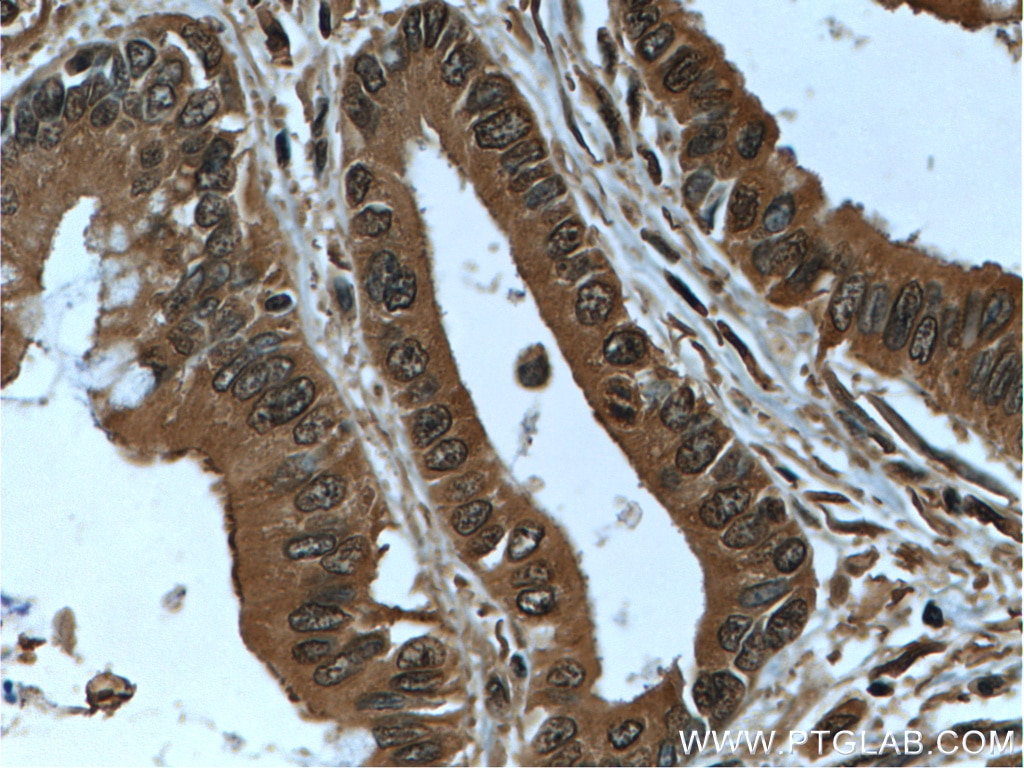 Immunohistochemistry (IHC) staining of human pancreas cancer tissue using IA-2/PTPRN Monoclonal antibody (66045-1-Ig)