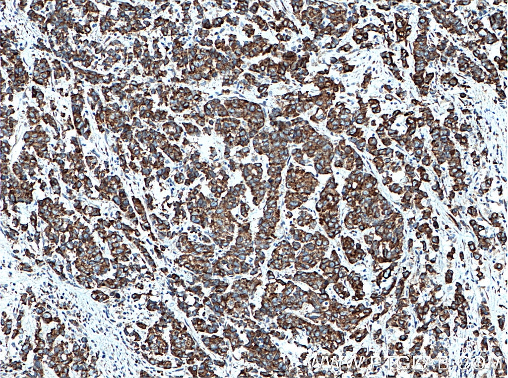 Immunohistochemistry (IHC) staining of human prostate cancer tissue using PTRH2 Polyclonal antibody (51006-2-AP)