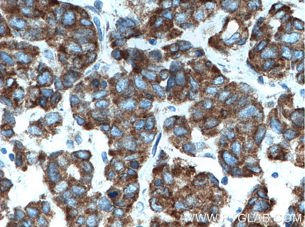 Immunohistochemistry (IHC) staining of human prostate cancer tissue using PTRH2 Polyclonal antibody (51006-2-AP)