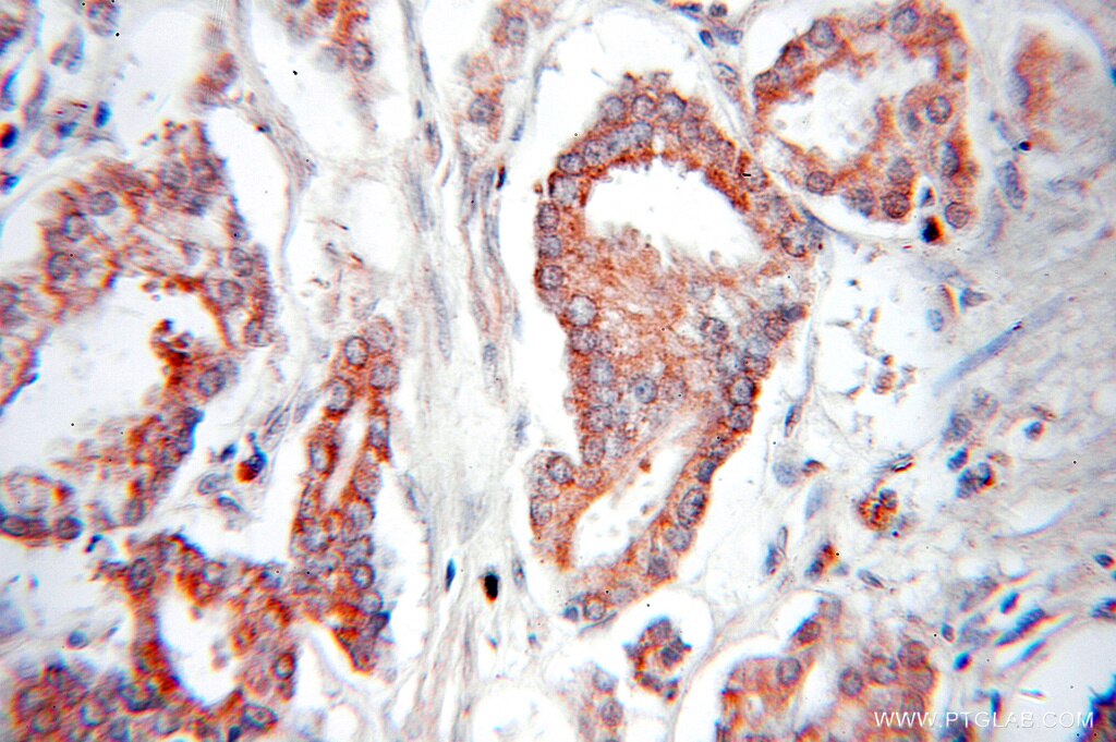 Immunohistochemistry (IHC) staining of human prostate cancer tissue using PTRH2 Polyclonal antibody (51006-2-AP)