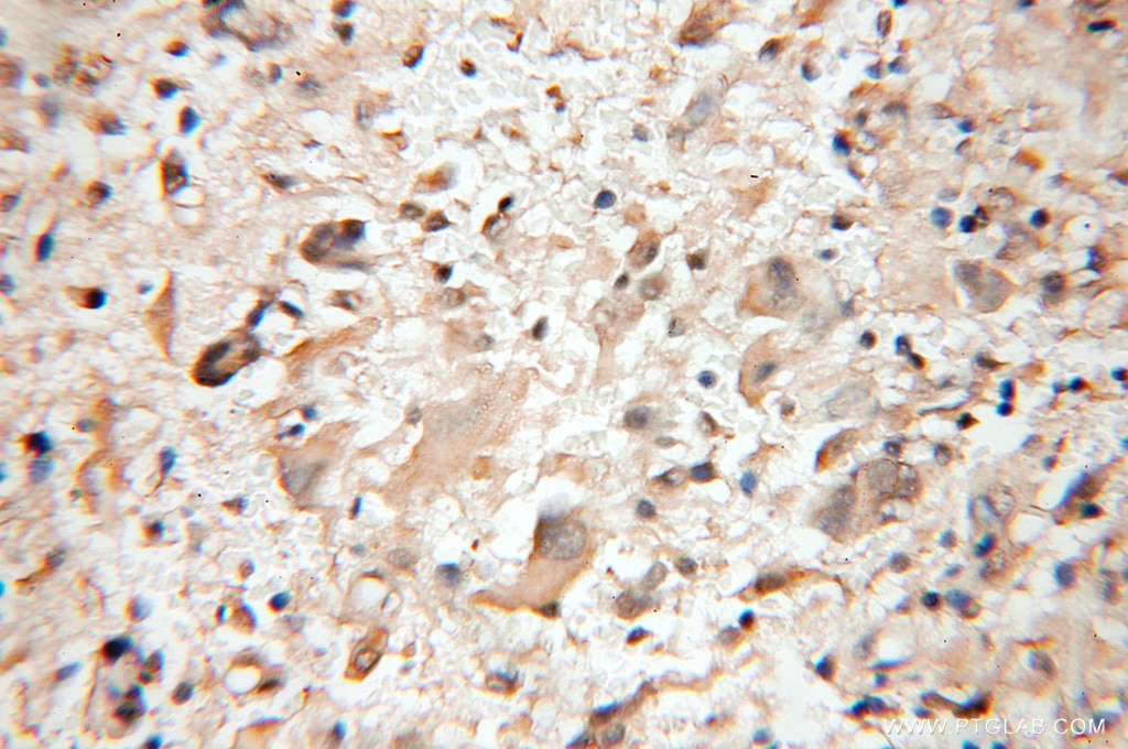 Immunohistochemistry (IHC) staining of human gliomas tissue using PTS Polyclonal antibody (12150-1-AP)