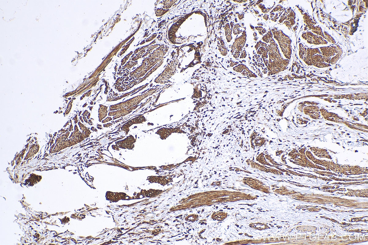 Immunohistochemistry (IHC) staining of human urothelial carcinoma tissue using Securin Polyclonal antibody (18040-1-AP)