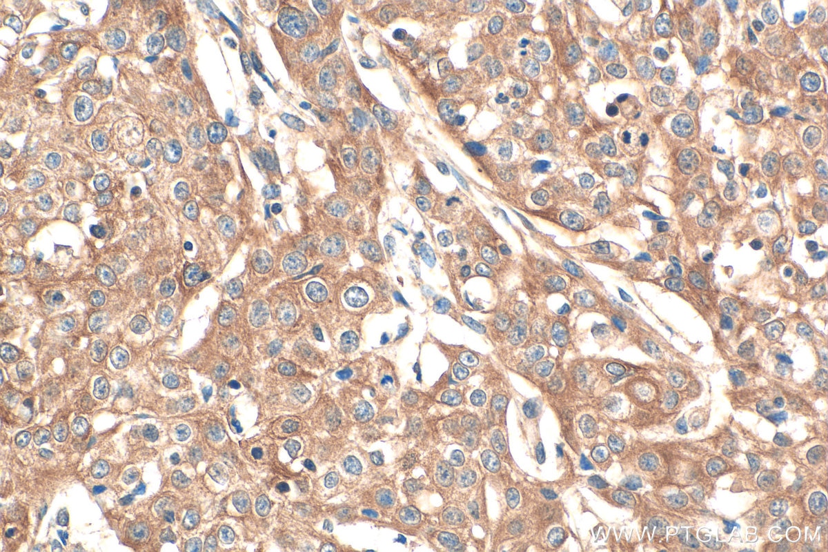 IHC staining of human cervical cancer using 13797-1-AP Immunohistochemistry (IHC) staining of human cervical cancer tissue using Pentraxin 3 Polyclonal antibody (13797-1-AP)