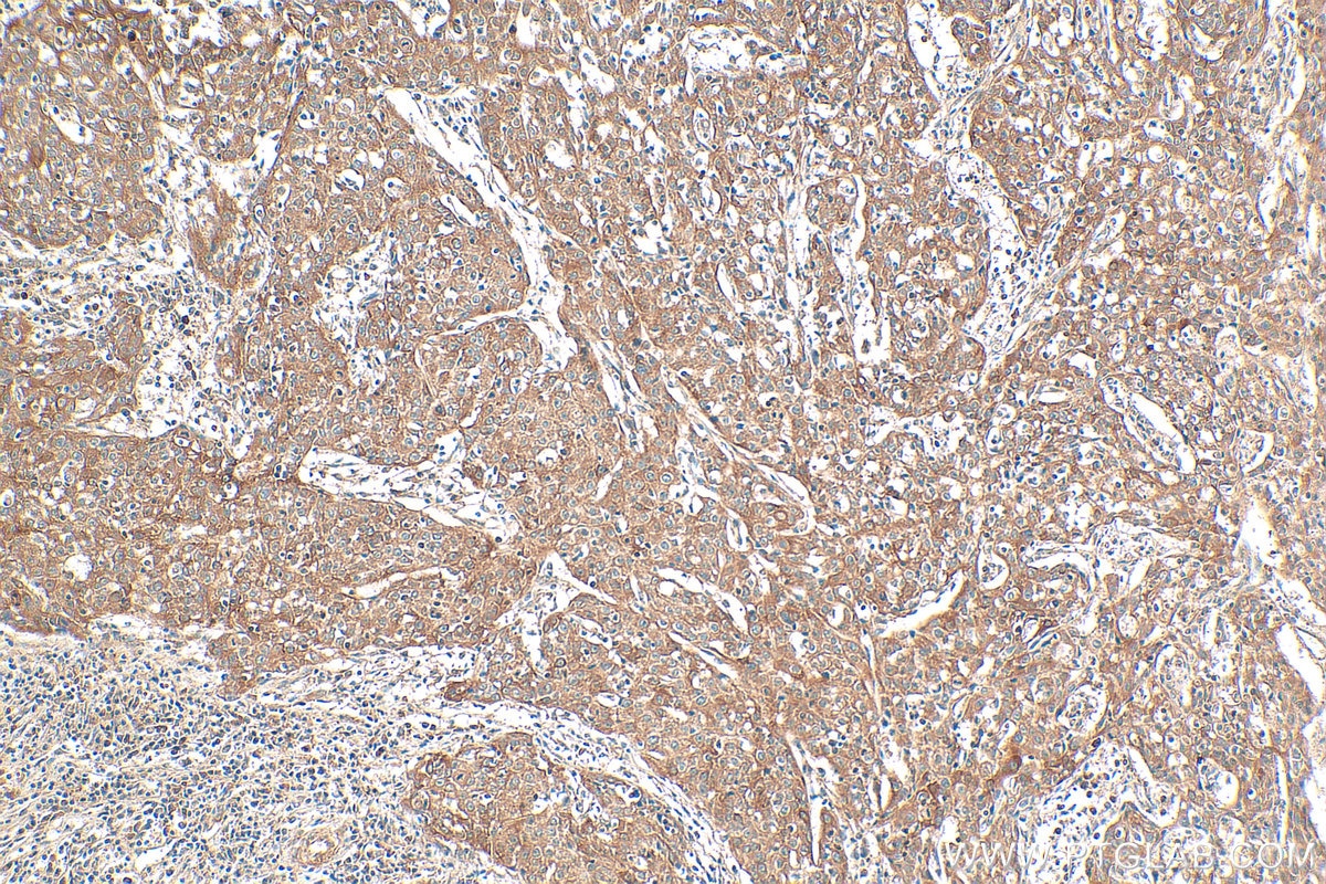 IHC staining of human cervical cancer using 13797-1-AP Immunohistochemistry (IHC) staining of human cervical cancer tissue using Pentraxin 3 Polyclonal antibody (13797-1-AP)