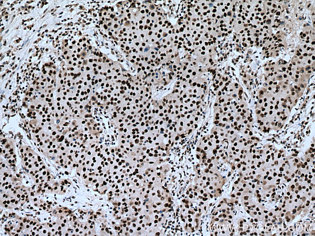 Immunohistochemistry (IHC) staining of human breast cancer tissue using PUF60 Polyclonal antibody (10810-1-AP)