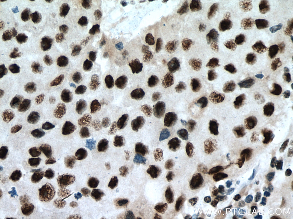 IHC staining of human breast cancer using 10810-1-AP