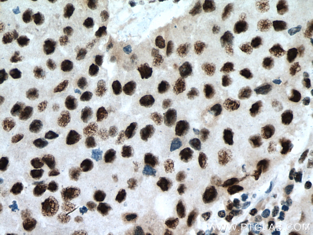 Immunohistochemistry (IHC) staining of human breast cancer tissue using PUF60 Polyclonal antibody (10810-1-AP)