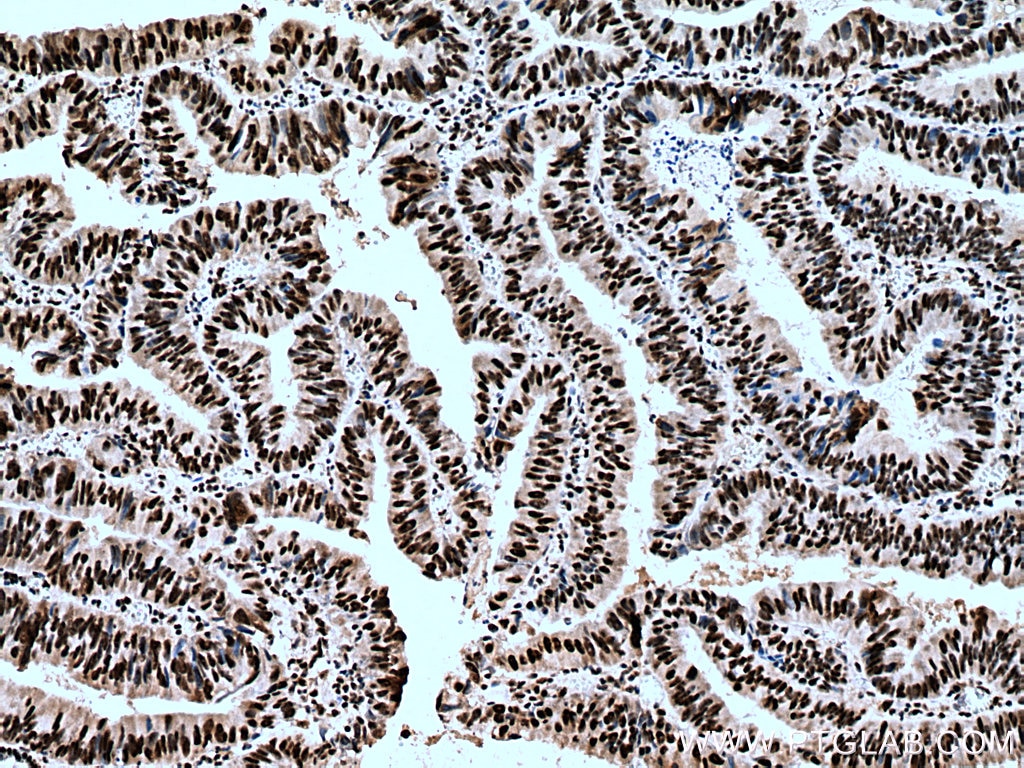 Immunohistochemistry (IHC) staining of human colon cancer tissue using PUF60 Polyclonal antibody (10810-1-AP)