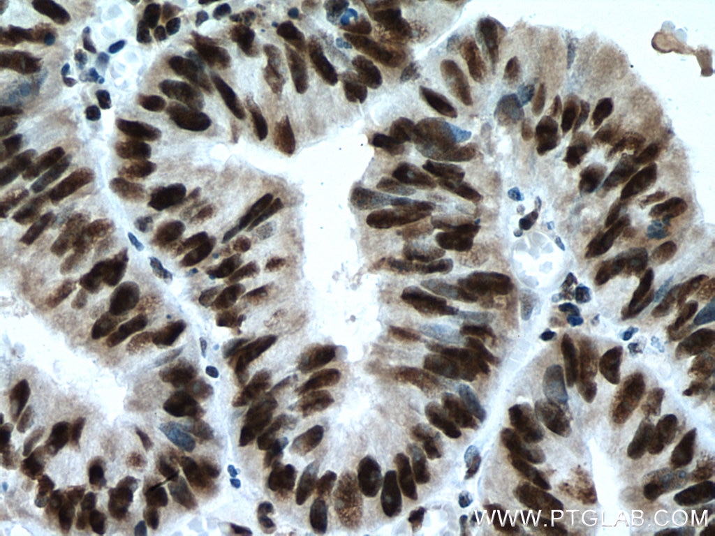 Immunohistochemistry (IHC) staining of human colon cancer tissue using PUF60 Polyclonal antibody (10810-1-AP)