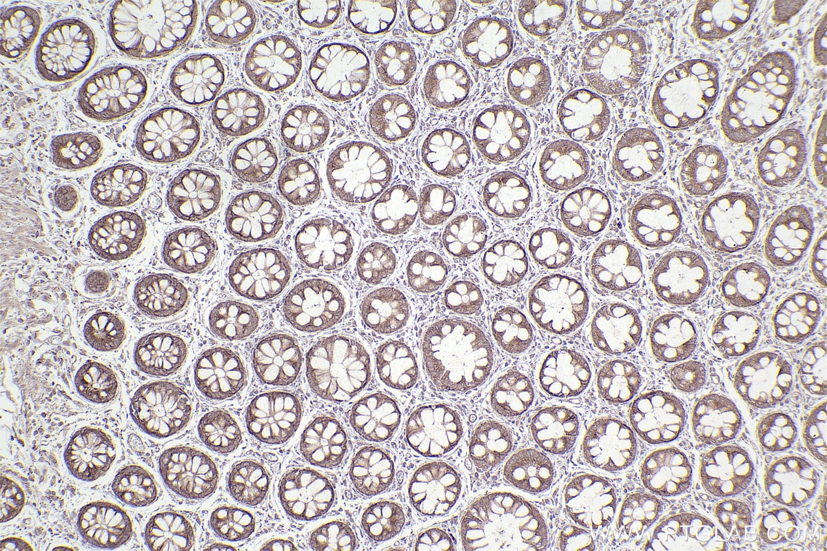 IHC staining of human rectal cancer using 26256-1-AP Immunohistochemistry (IHC) staining of human rectal cancer tissue using PUM1 Polyclonal antibody (26256-1-AP)