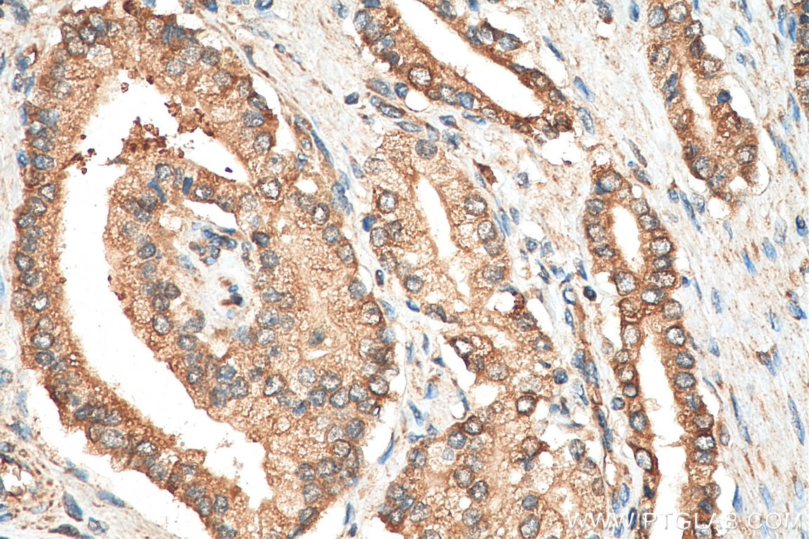 Immunohistochemistry (IHC) staining of human prostate cancer tissue using PUMA Polyclonal antibody (55120-1-AP)
