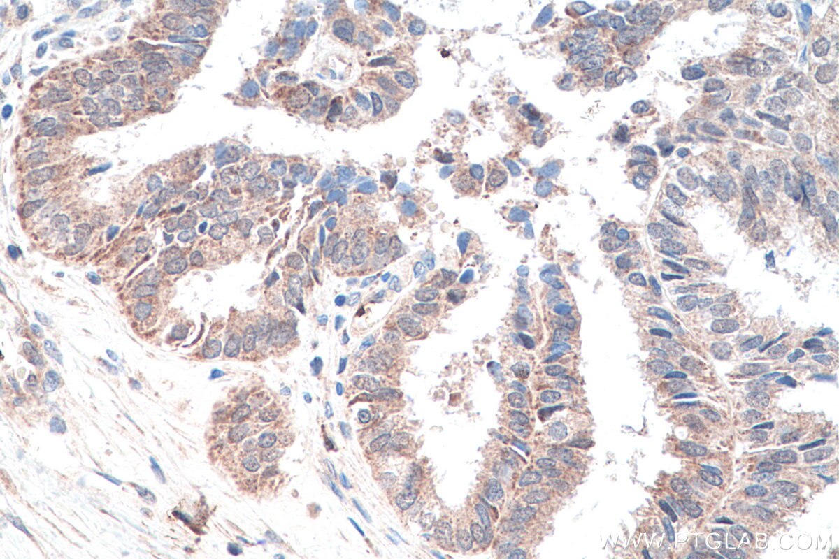 IHC staining of human ovary tumor using 11512-1-AP