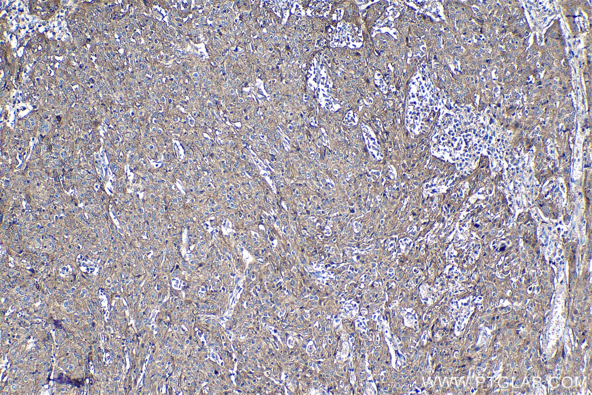 Immunohistochemistry (IHC) staining of human cervical cancer tissue using CD155/PVR Polyclonal antibody (27486-1-AP)