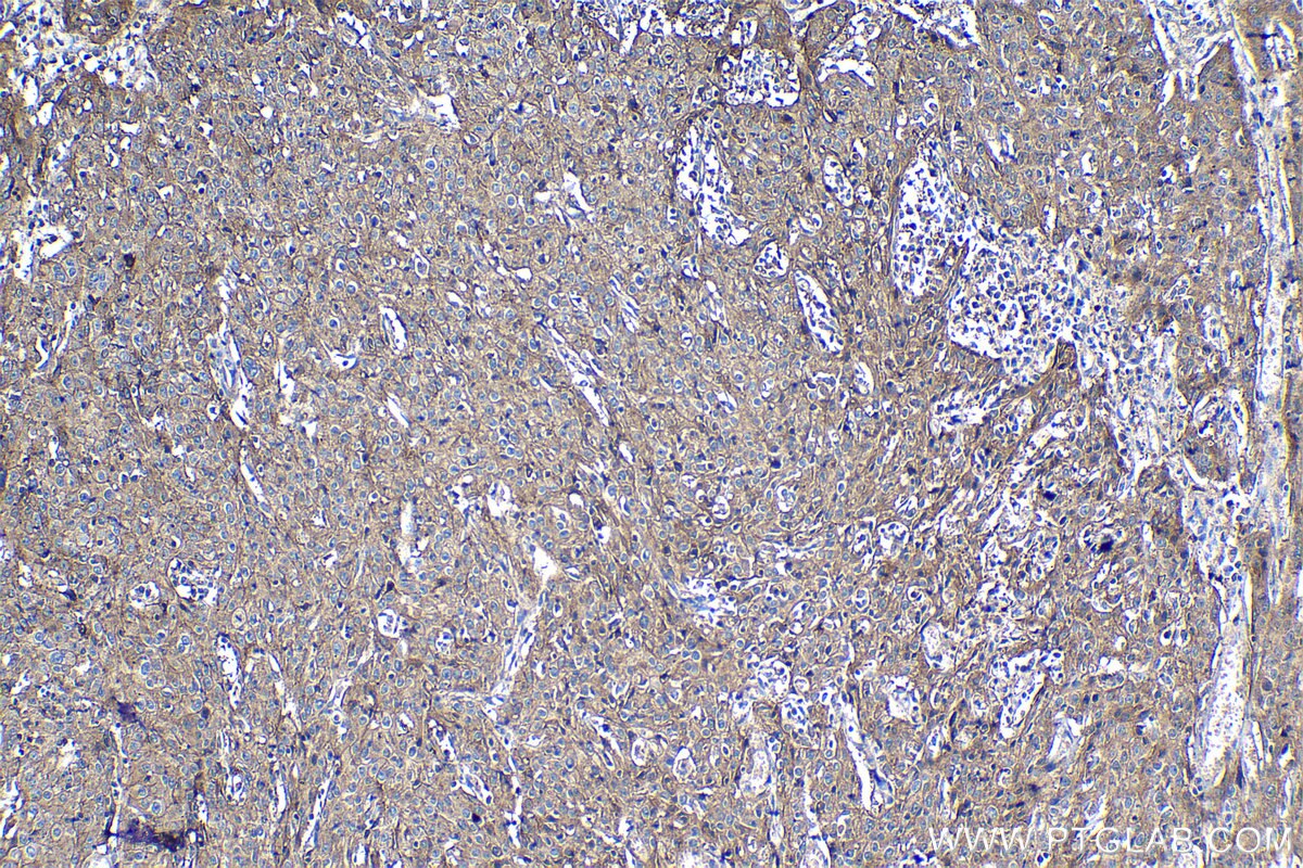 Immunohistochemistry (IHC) staining of human cervical cancer tissue using Poliovirus receptor Polyclonal antibody (27486-1-AP)