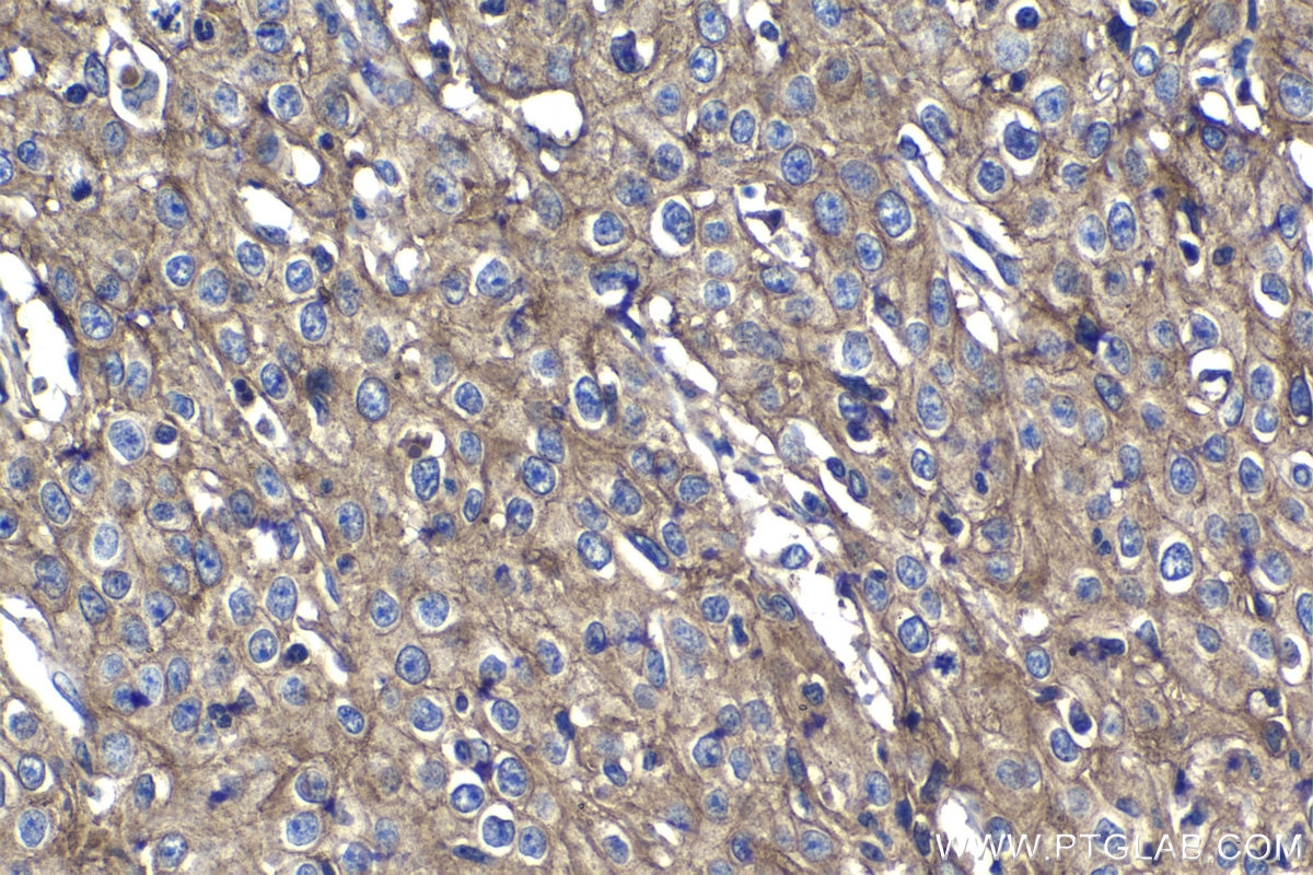 Immunohistochemistry (IHC) staining of human cervical cancer tissue using CD155/PVR Polyclonal antibody (27486-1-AP)