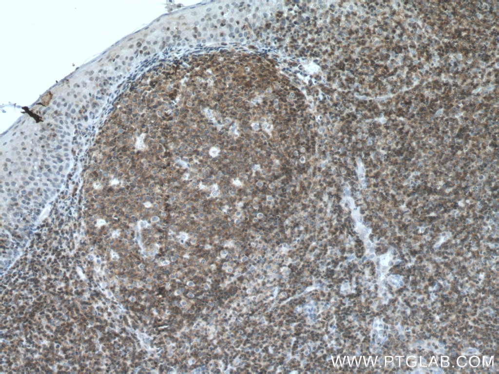 Immunohistochemistry (IHC) staining of human tonsillitis tissue using PVRIG Polyclonal antibody (21448-1-AP)