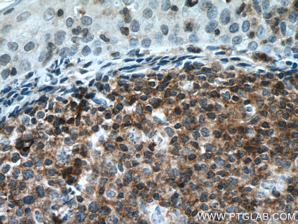 Immunohistochemistry (IHC) staining of human tonsillitis tissue using PVRIG Polyclonal antibody (21448-1-AP)