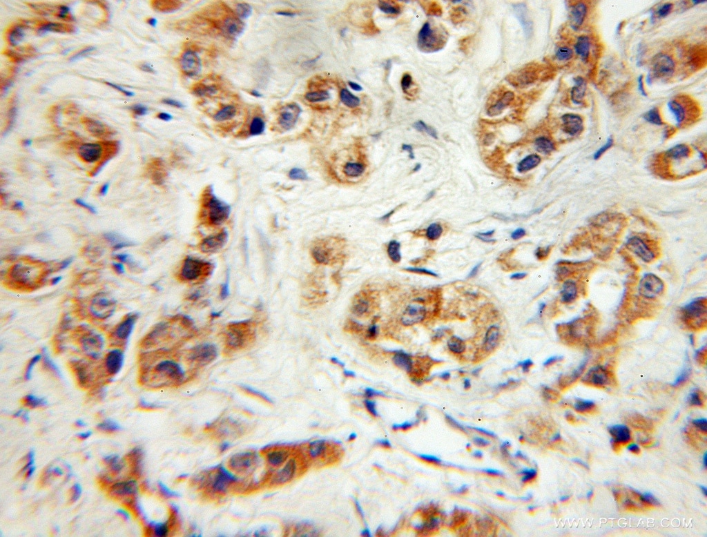 Immunohistochemistry (IHC) staining of human prostate cancer tissue using Nectin-3/PVRL3 Polyclonal antibody (11213-1-AP)