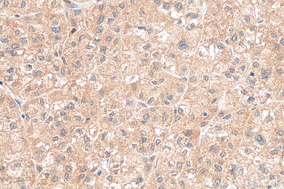 Immunohistochemistry (IHC) staining of human liver cancer tissue using Paxillin Polyclonal antibody (10029-1-Ig)