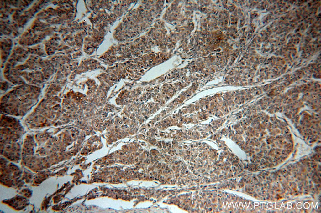 Immunohistochemistry (IHC) staining of human liver cancer tissue using Paxillin Polyclonal antibody (10029-1-Ig)