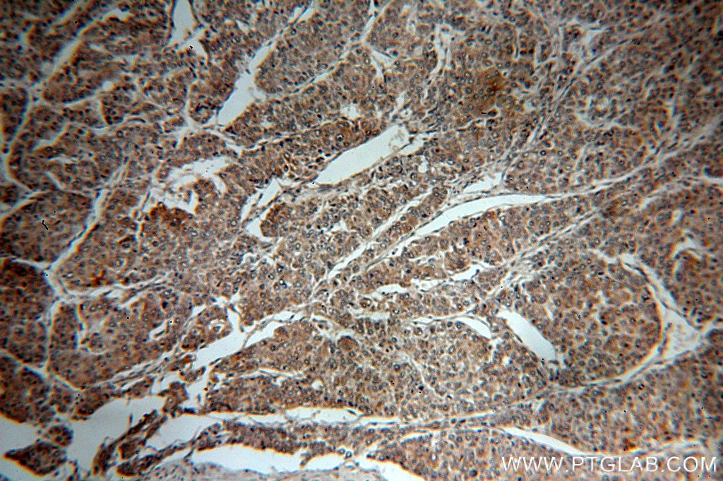 IHC staining of human liver cancer using 10029-1-Ig