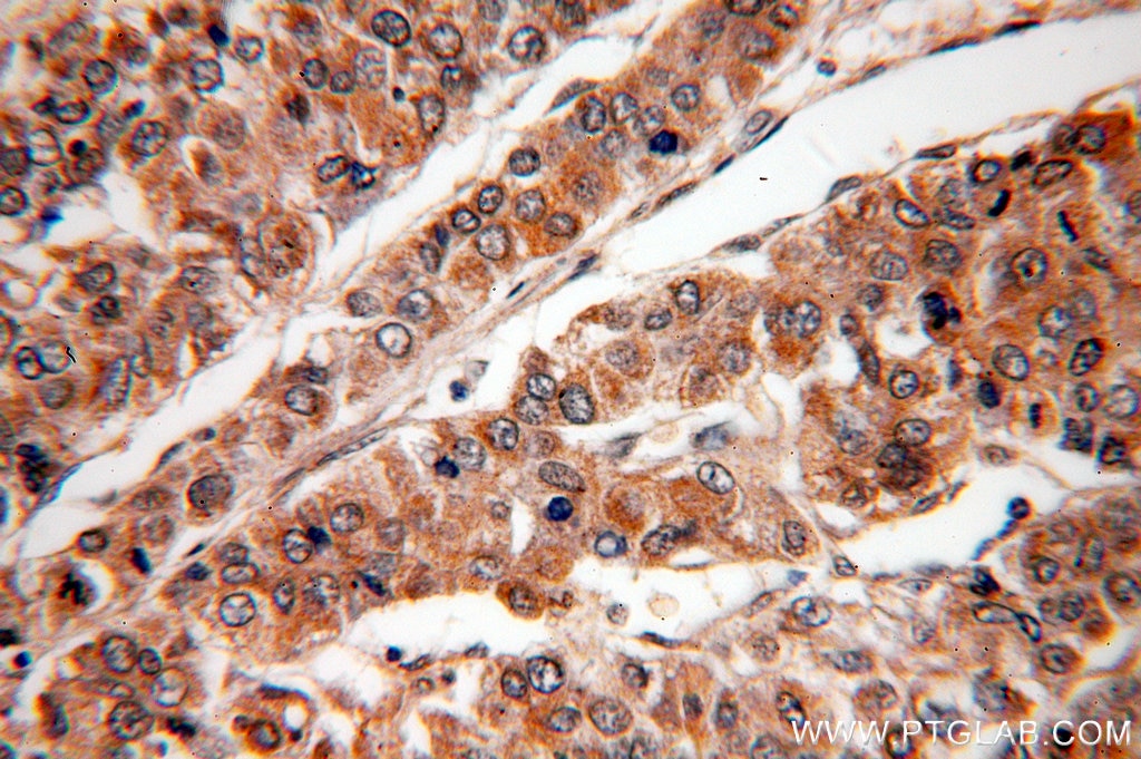 Immunohistochemistry (IHC) staining of human liver cancer tissue using Paxillin Polyclonal antibody (10029-1-Ig)