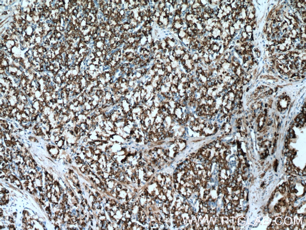 Immunohistochemistry (IHC) staining of human prostate cancer tissue using PYCR1 Polyclonal antibody (13108-1-AP)