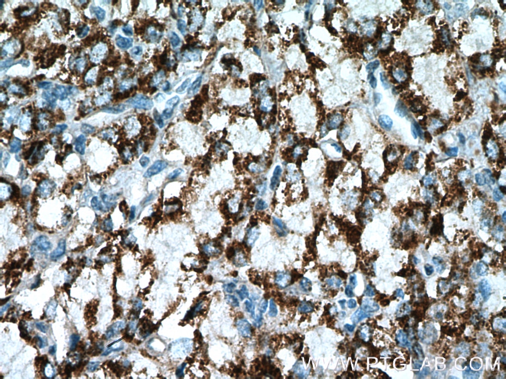Immunohistochemistry (IHC) staining of human prostate cancer tissue using PYCR1 Polyclonal antibody (13108-1-AP)