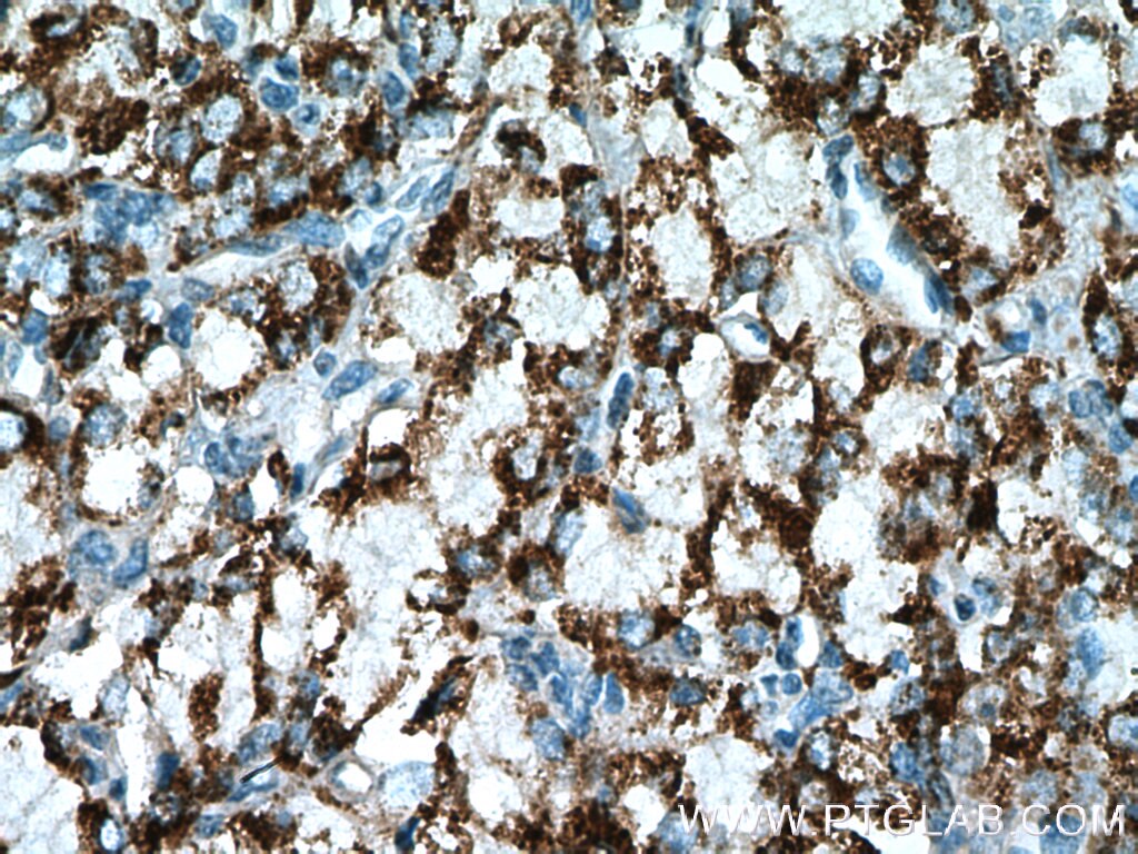 IHC staining of human prostate cancer using 13108-1-AP