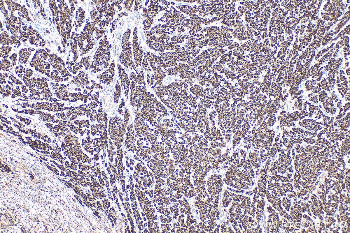 Immunohistochemistry (IHC) staining of human colon cancer tissue using PYCR1 Polyclonal antibody (13108-1-AP)