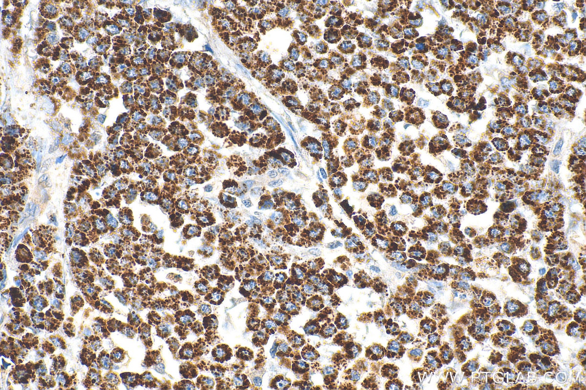 Immunohistochemistry (IHC) staining of human colon cancer tissue using PYCR1 Polyclonal antibody (13108-1-AP)