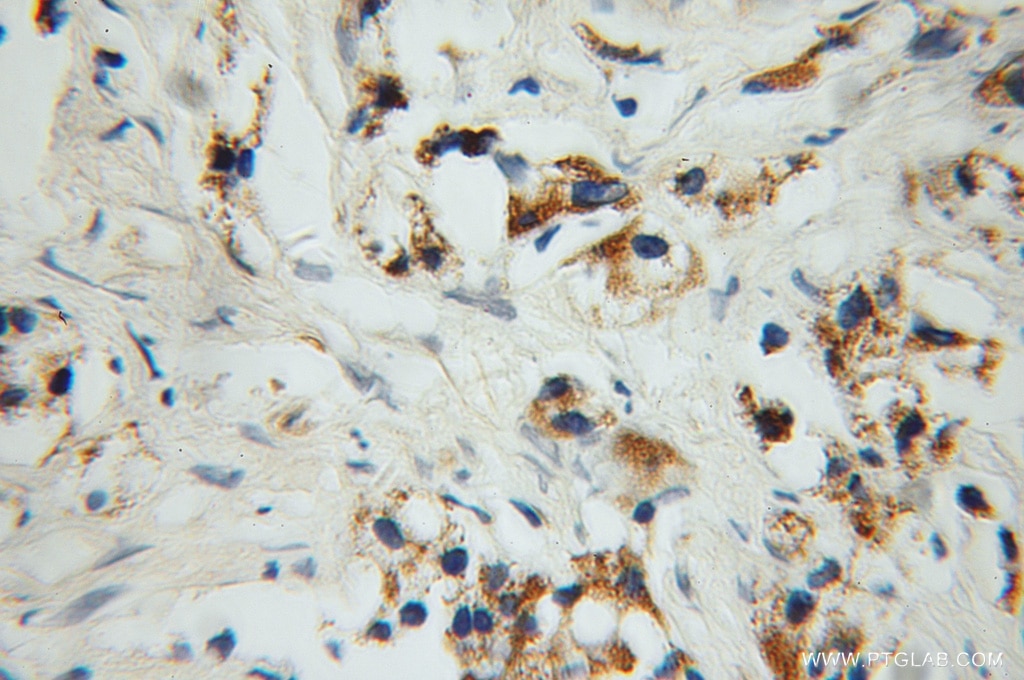 Immunohistochemistry (IHC) staining of human prostate cancer tissue using PYCR1 Polyclonal antibody (13108-1-AP)