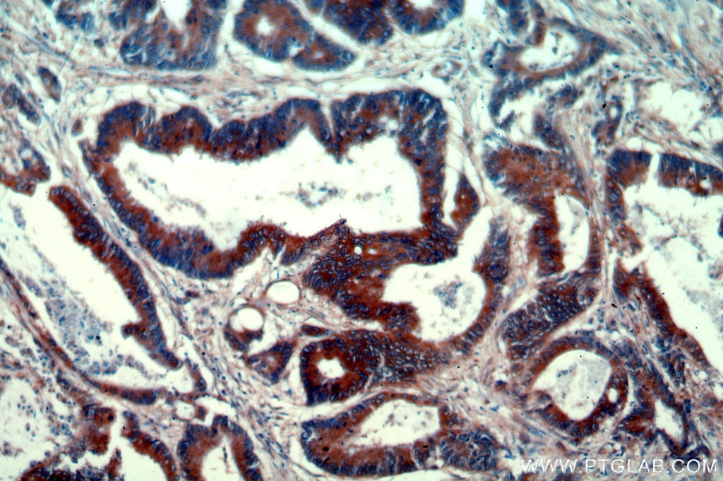 Immunohistochemistry (IHC) staining of human colon cancer tissue using PYCR1-specific Polyclonal antibody (20962-1-AP)