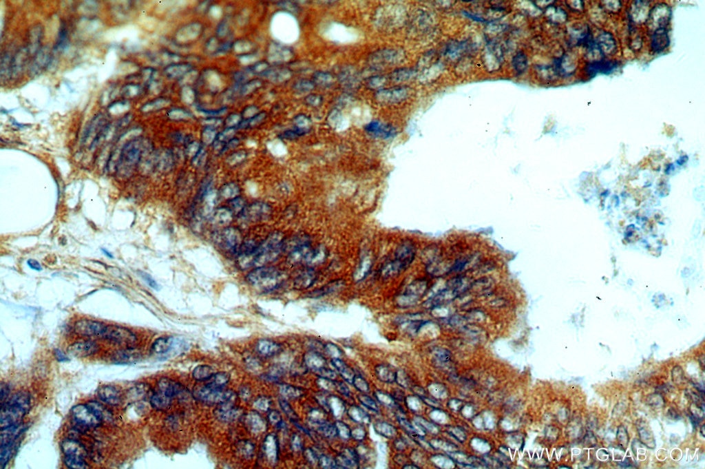Immunohistochemistry (IHC) staining of human colon cancer tissue using PYCR1-specific Polyclonal antibody (20962-1-AP)