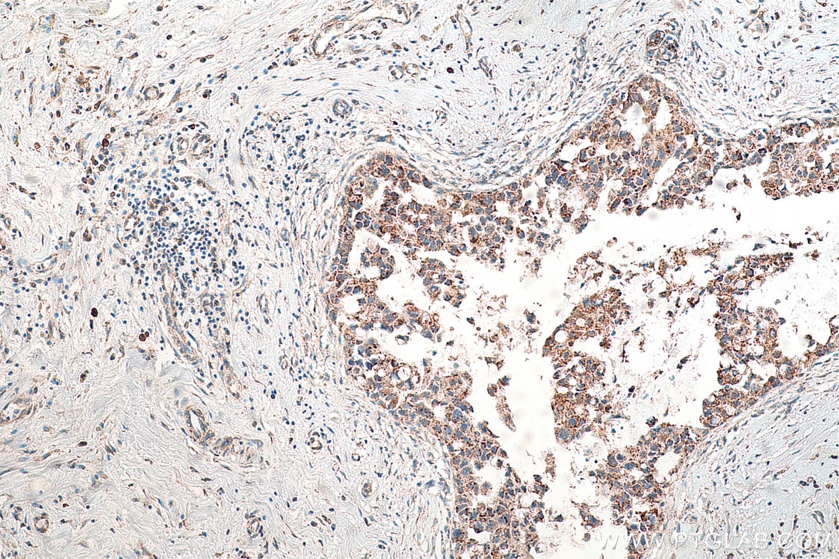 Immunohistochemistry (IHC) staining of human breast cancer tissue using PYCR1 Monoclonal antibody (66510-1-Ig)