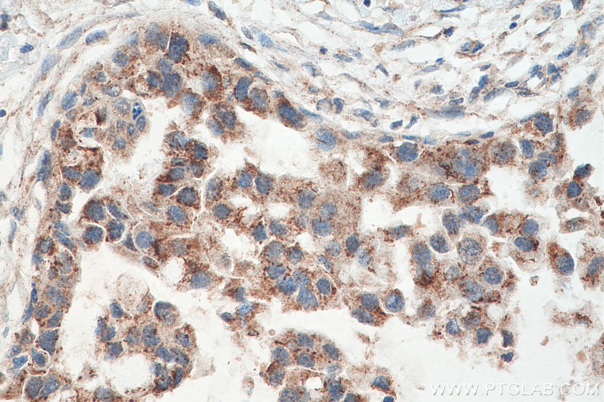 Immunohistochemistry (IHC) staining of human breast cancer tissue using PYCR1 Monoclonal antibody (66510-1-Ig)