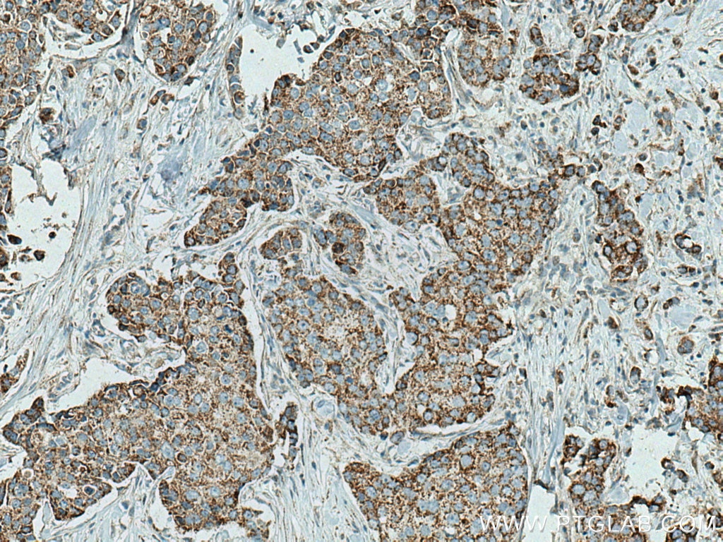 Immunohistochemistry (IHC) staining of human breast cancer tissue using PYCR2 Polyclonal antibody (17146-1-AP)