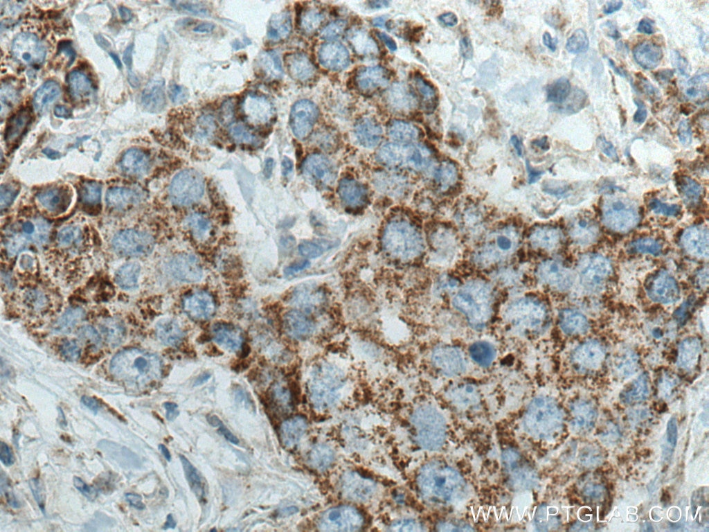 Immunohistochemistry (IHC) staining of human breast cancer tissue using PYCR2 Polyclonal antibody (17146-1-AP)