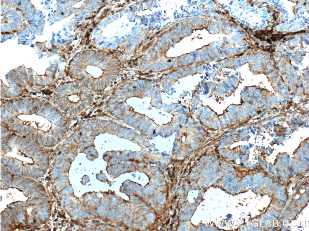 Immunohistochemistry (IHC) staining of human colon cancer tissue using Beta Actin Monoclonal antibody (66009-1-Ig)