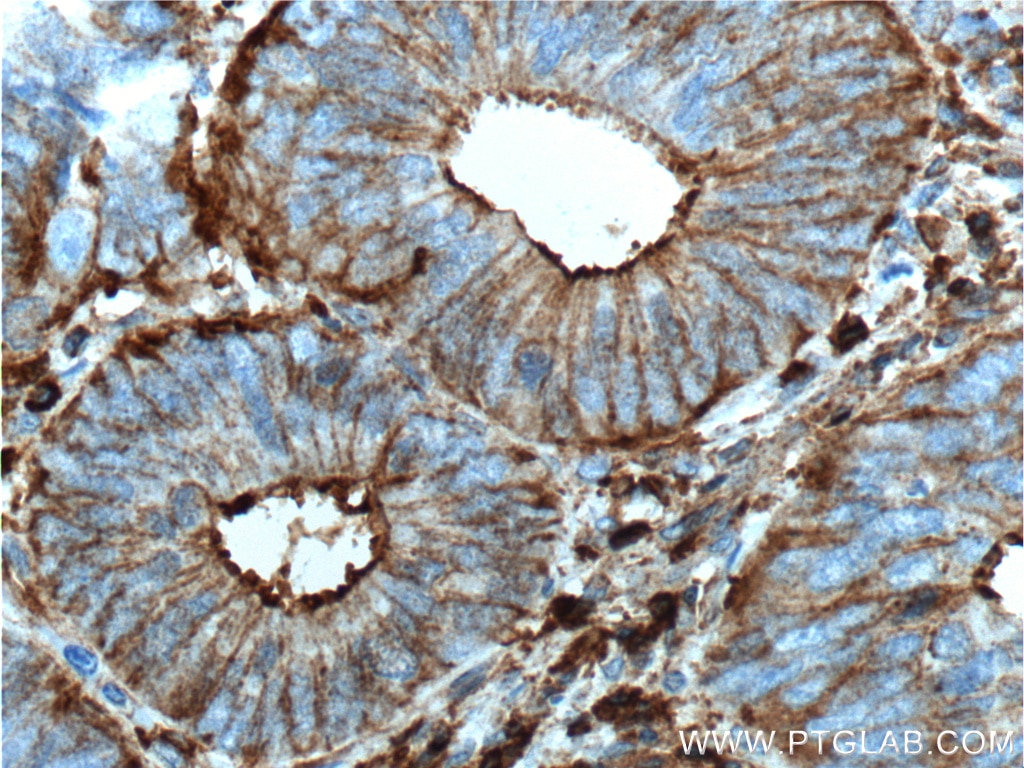 IHC analysis of paraffin-embedded human colon cancer tissue slide using 66009-1-Ig( beta actin Antibody) at dilution of 1:1000 (under 40x lens). heat mediated antigen retrieved with Tris-EDTA buffer(pH9)